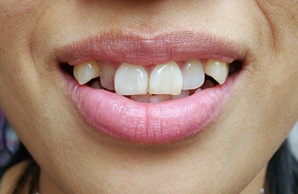 歯並び・噛み合わせの乱れによる悪影響